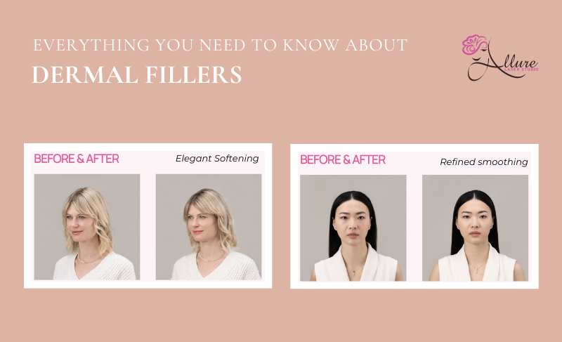 Everything You Ever Wanted to Know About Dermal Fillers - Allure Laser Studio