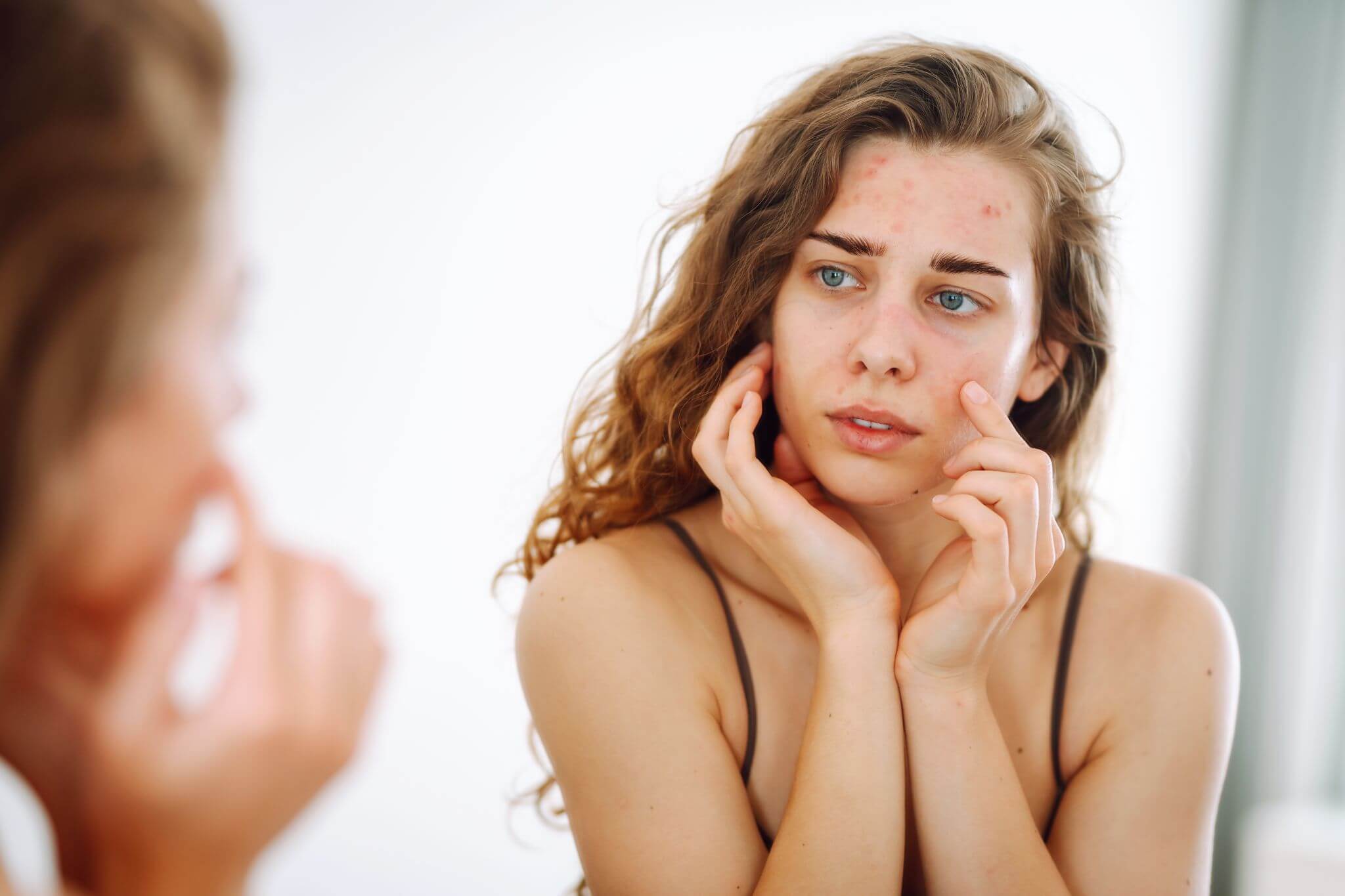 How to Treat Severe Acne