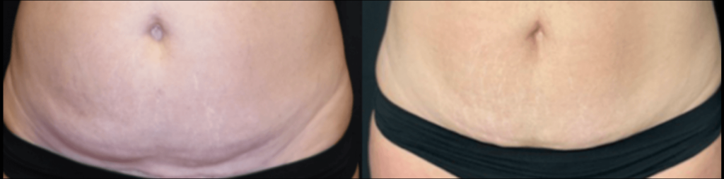 Understanding and Eliminating Cellulite