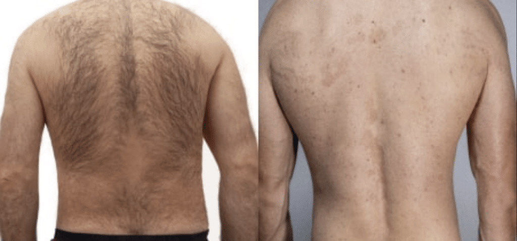 4 Myths & Facts About Laser Hair Removal | Allure Laser Studio