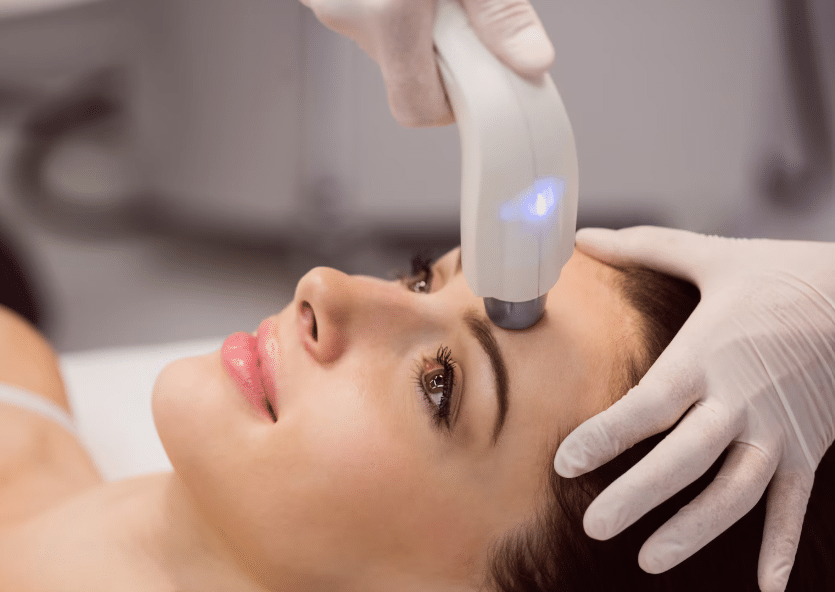 microneedling