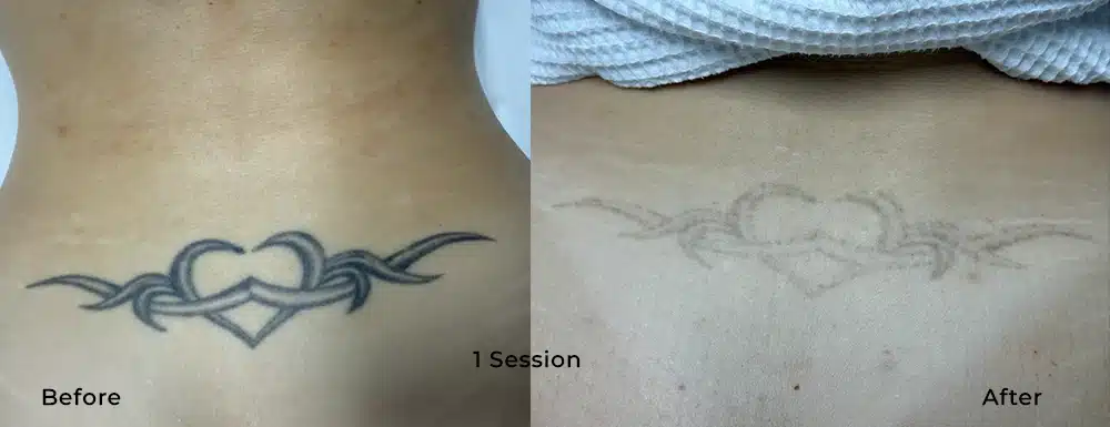 Lower back tattoo before and after 1 VANISH PRO laser tattoo removal session