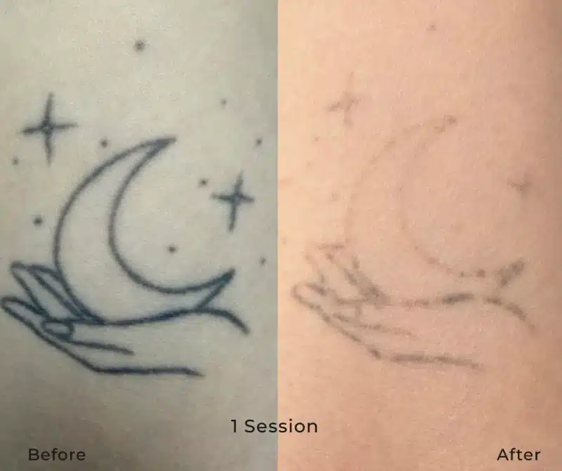 Moon and stars tattoo before and after 1 VANISH PRO laser tattoo removal session