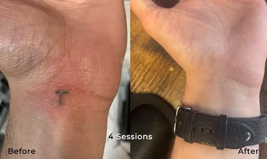 Wrist tattoo before and after 4 VANISH PRO laser tattoo removal sessions